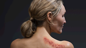 שלבקת חוגרת, צילום: GSK